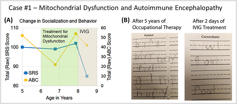 IVIG for the treatment of autoimmune encephalopathy