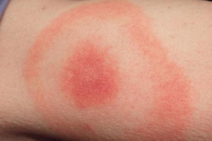 Lyme Disease Rashes